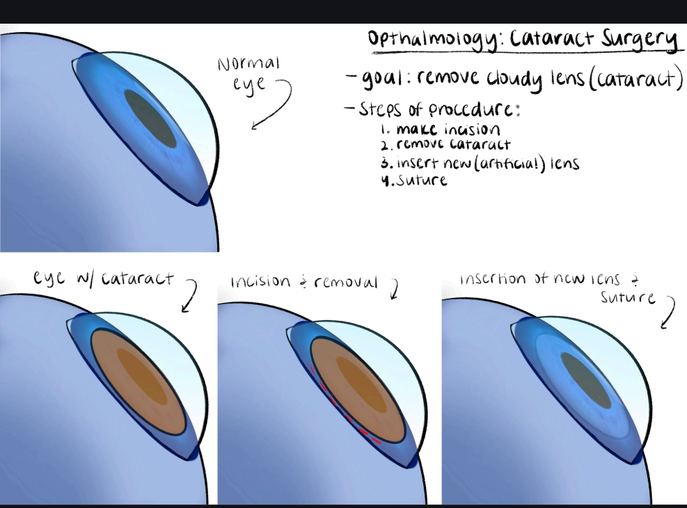 Fellow's four-panel drawing of the steps of cataract surgery from normal eye to new lens insertion