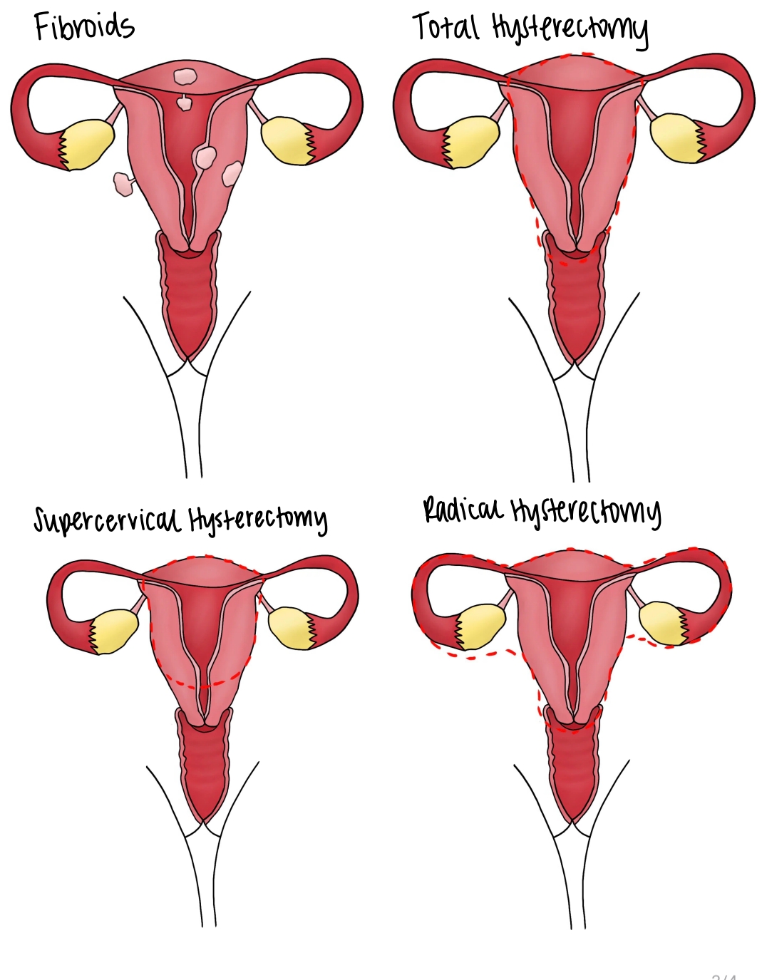 Fellow's four-panel drawing of uterine fibroids with total, supracervical and radical hysterectomy resection lines