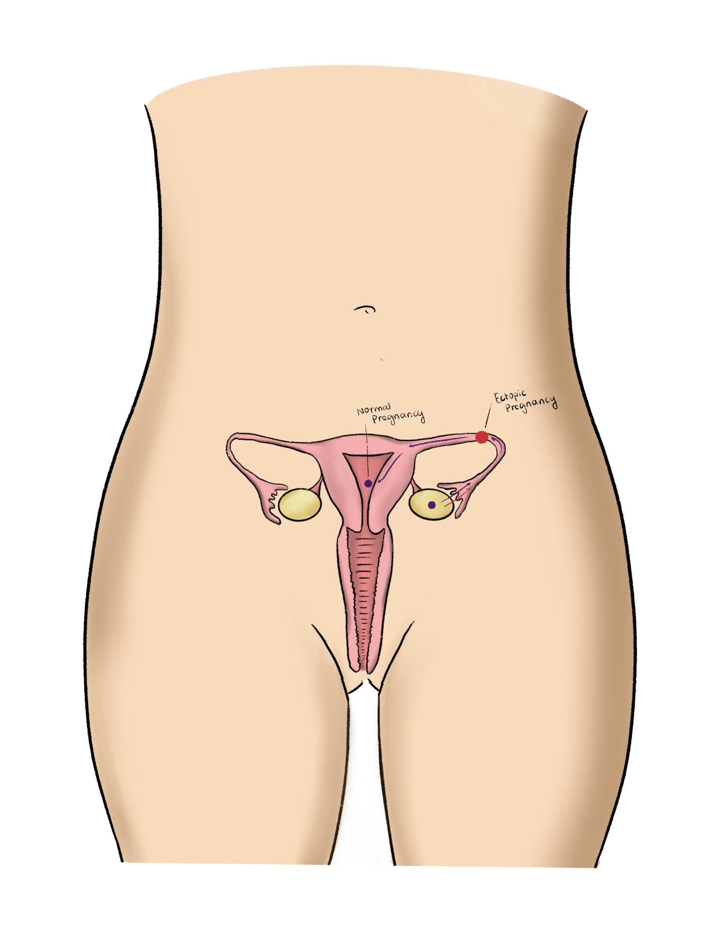 Fellow's drawing comparing a normal pregnancy with an ectopic pregnancy in the fallopian tube