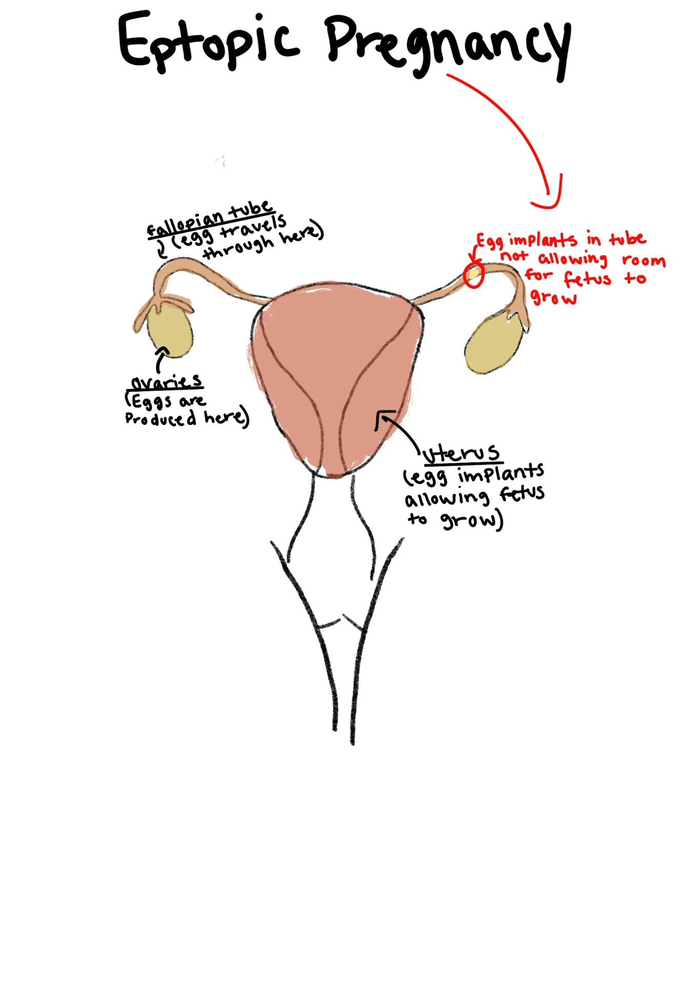 Fellow's labelled drawing of an ectopic pregnancy with fallopian tube, ovaries and uterus annotations