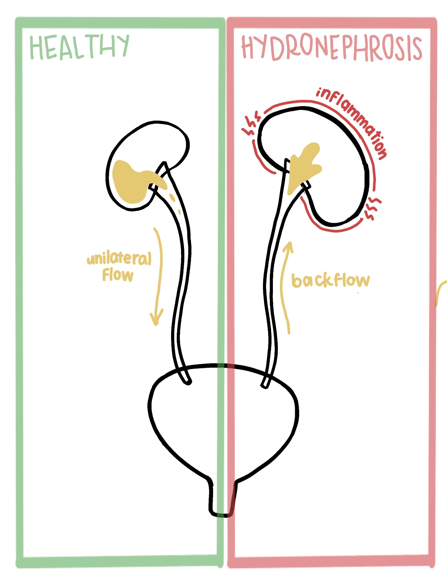 Fellow's side-by-side drawing of a healthy kidney with unilateral flow and hydronephrosis with backflow and inflammation