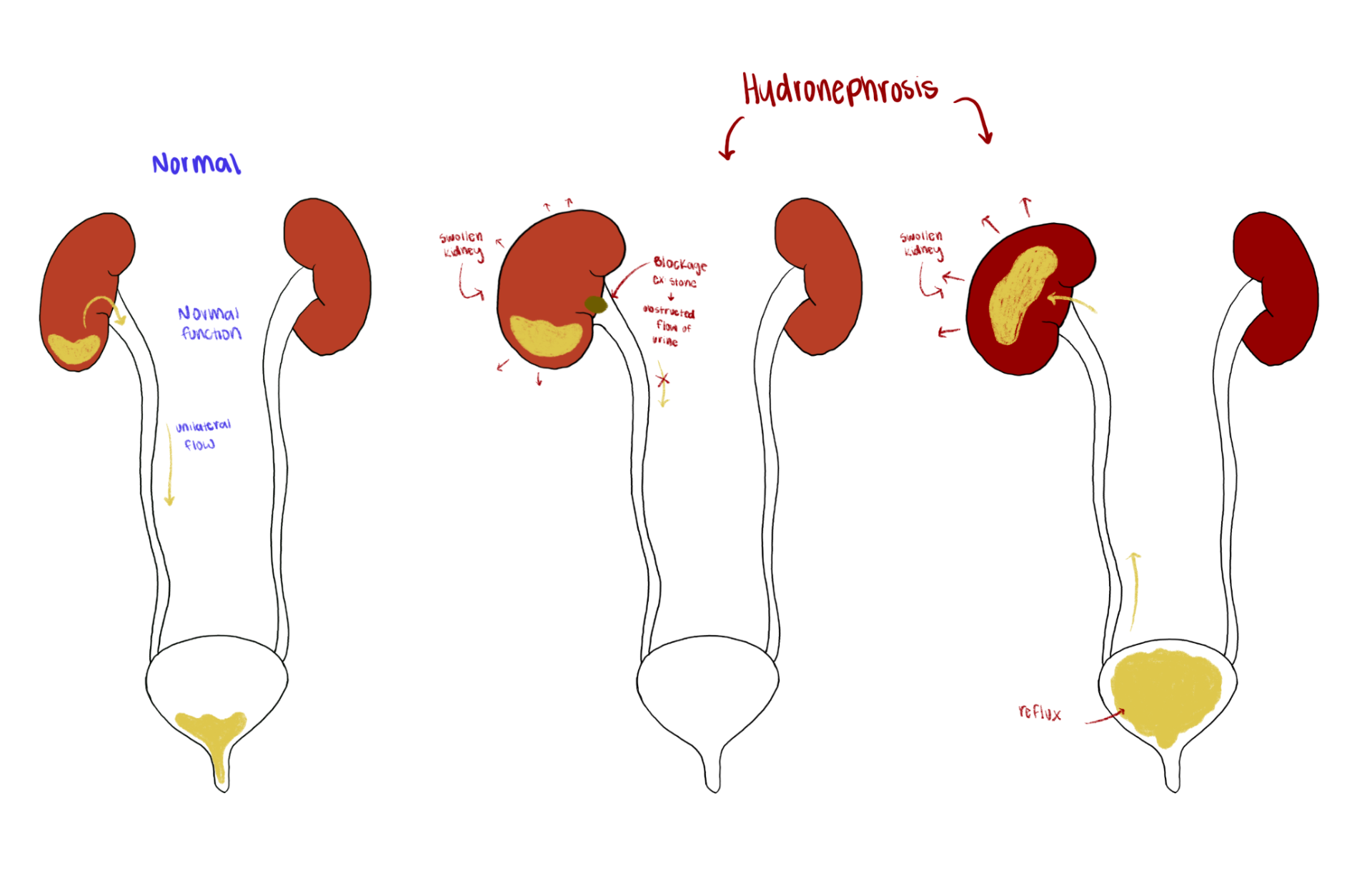 Fellow's drawing comparing normal kidney drainage with hydronephrosis from blockage and reflux