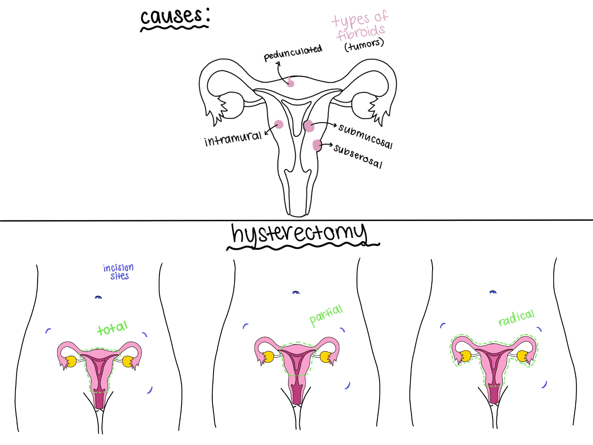 Fellow's drawing of fibroid types in the uterus and total, partial and radical hysterectomy incision sites