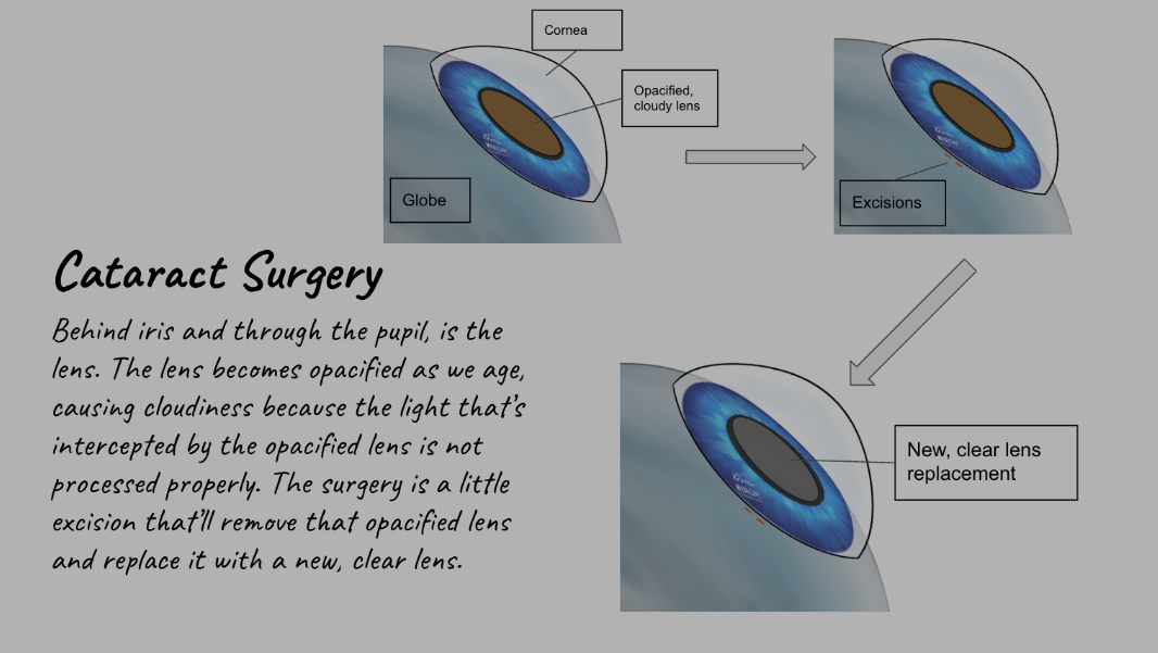 Fellow's labelled explainer of cataract surgery with cornea, opacified lens, excisions and new clear lens