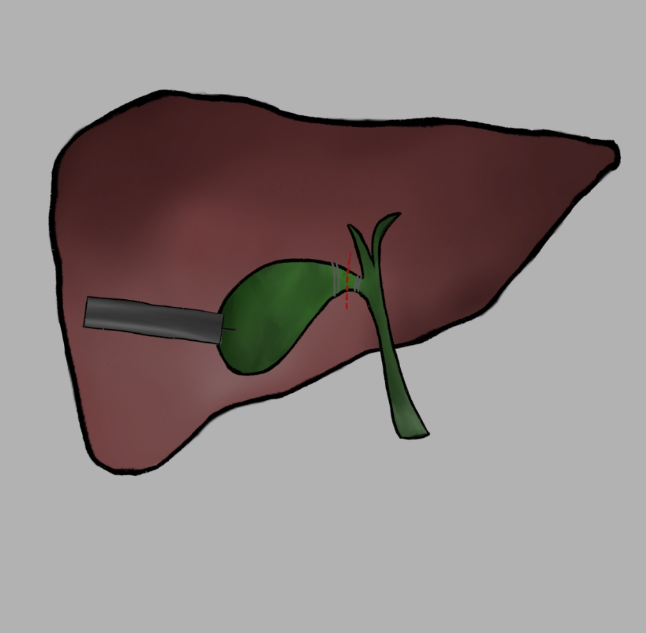 Fellow's drawing of the liver and gallbladder during a laparoscopic cholecystectomy