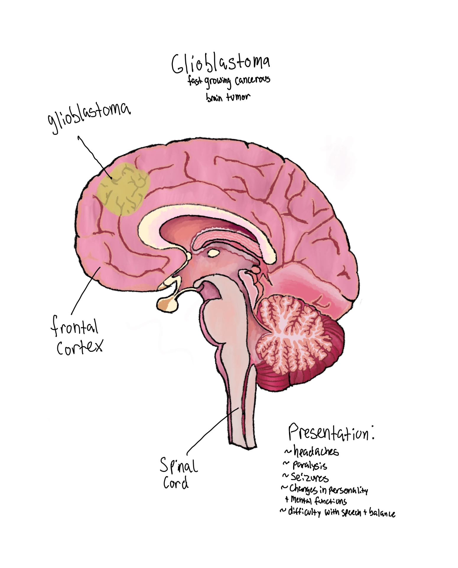 Fellow's labelled drawing of a glioblastoma in the frontal cortex with presentation notes