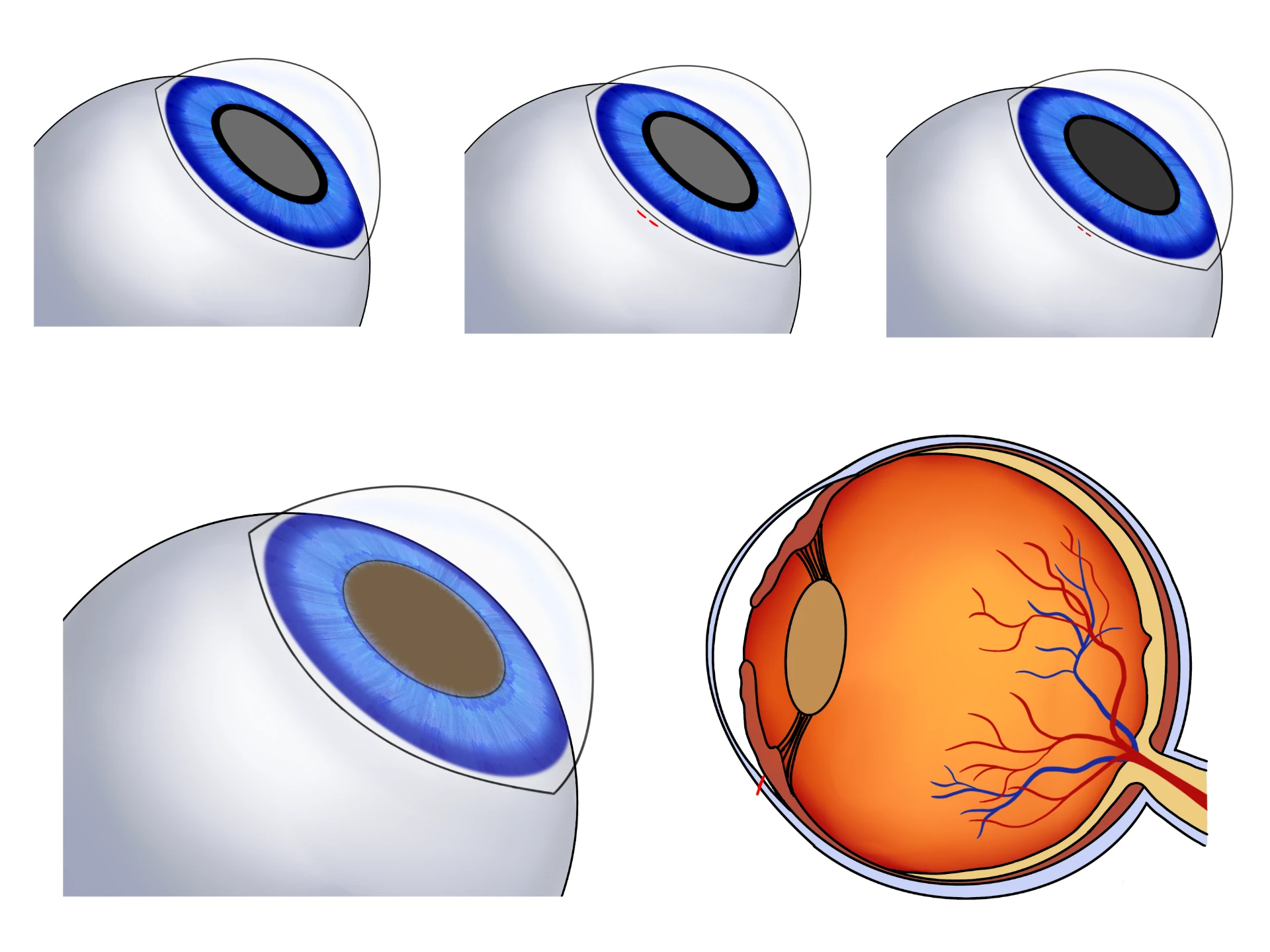 Fellow's multi-panel drawing of the eye showing corneal incision, lens clouding stages and a cross-section of the eye with retinal vessels