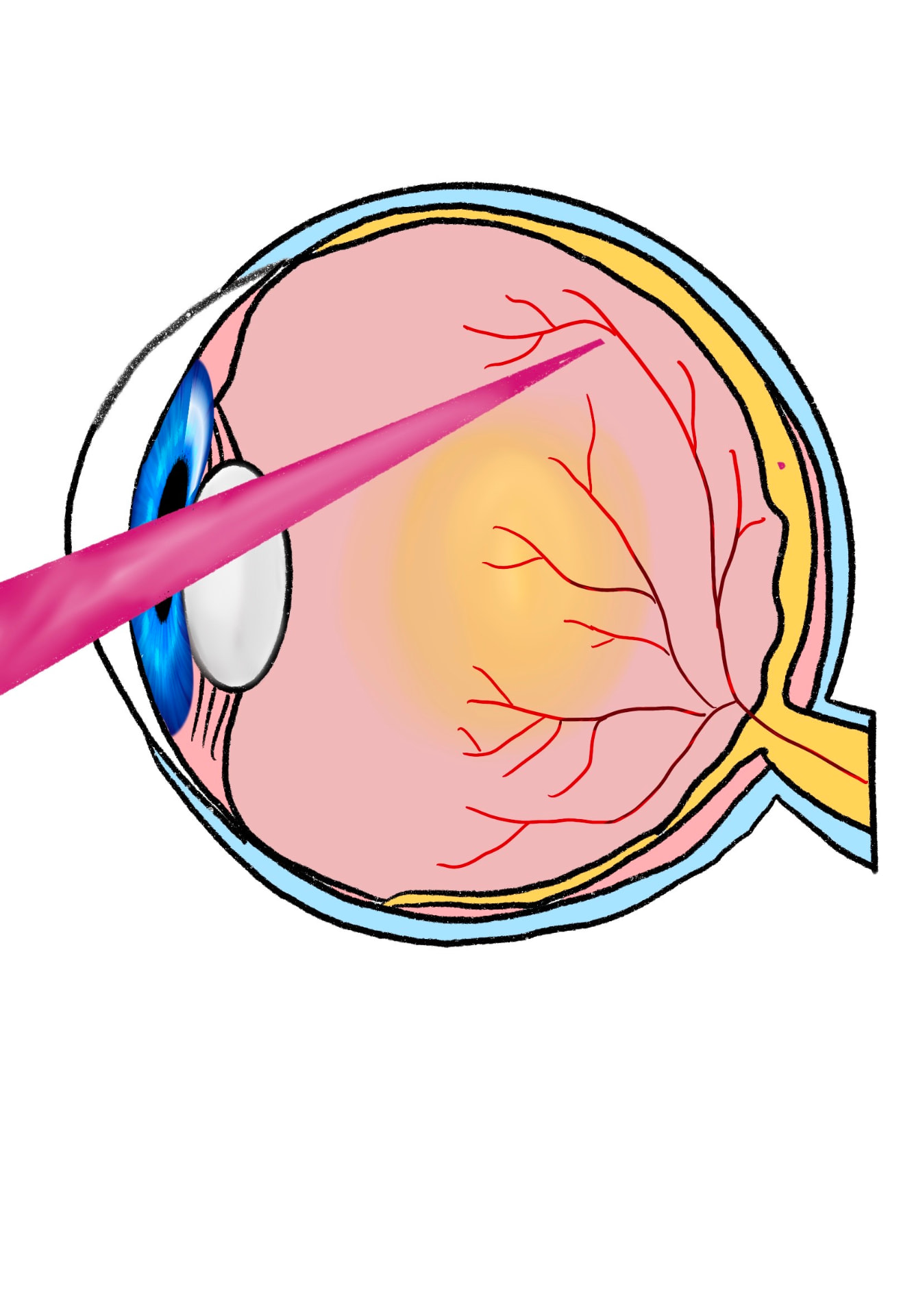 Fellow's cross-section drawing of the eye with a laser beam passing through the lens toward the retina