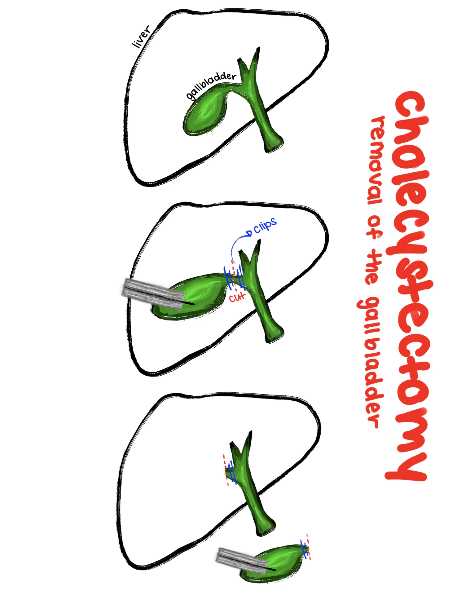 Fellow's three-panel drawing of a cholecystectomy showing the liver, gallbladder, clips on the cystic duct and removal