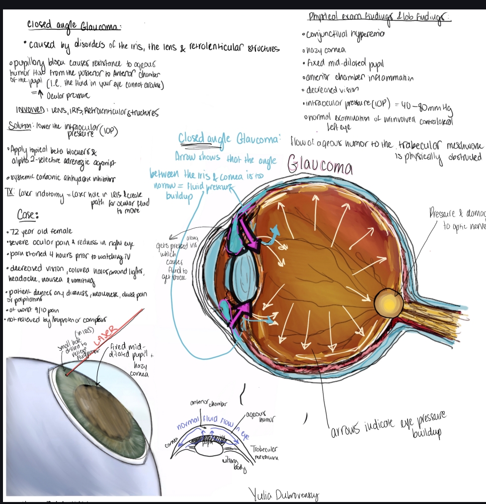 Fellow's annotated case drawing of closed angle glaucoma showing fluid pressure buildup inside the eye