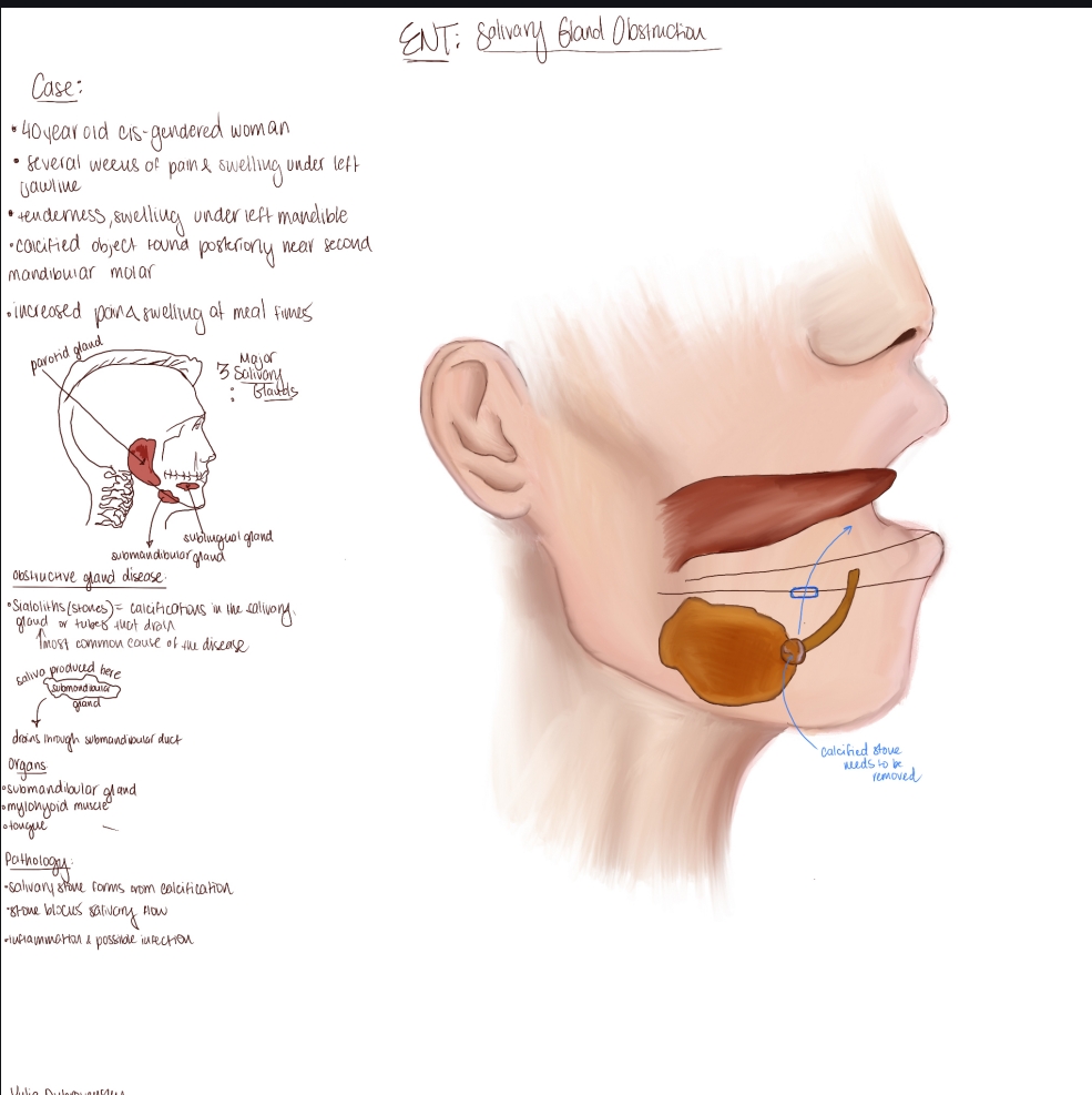 Fellow's annotated case drawing of salivary gland obstruction with the submandibular gland and a calcified stone