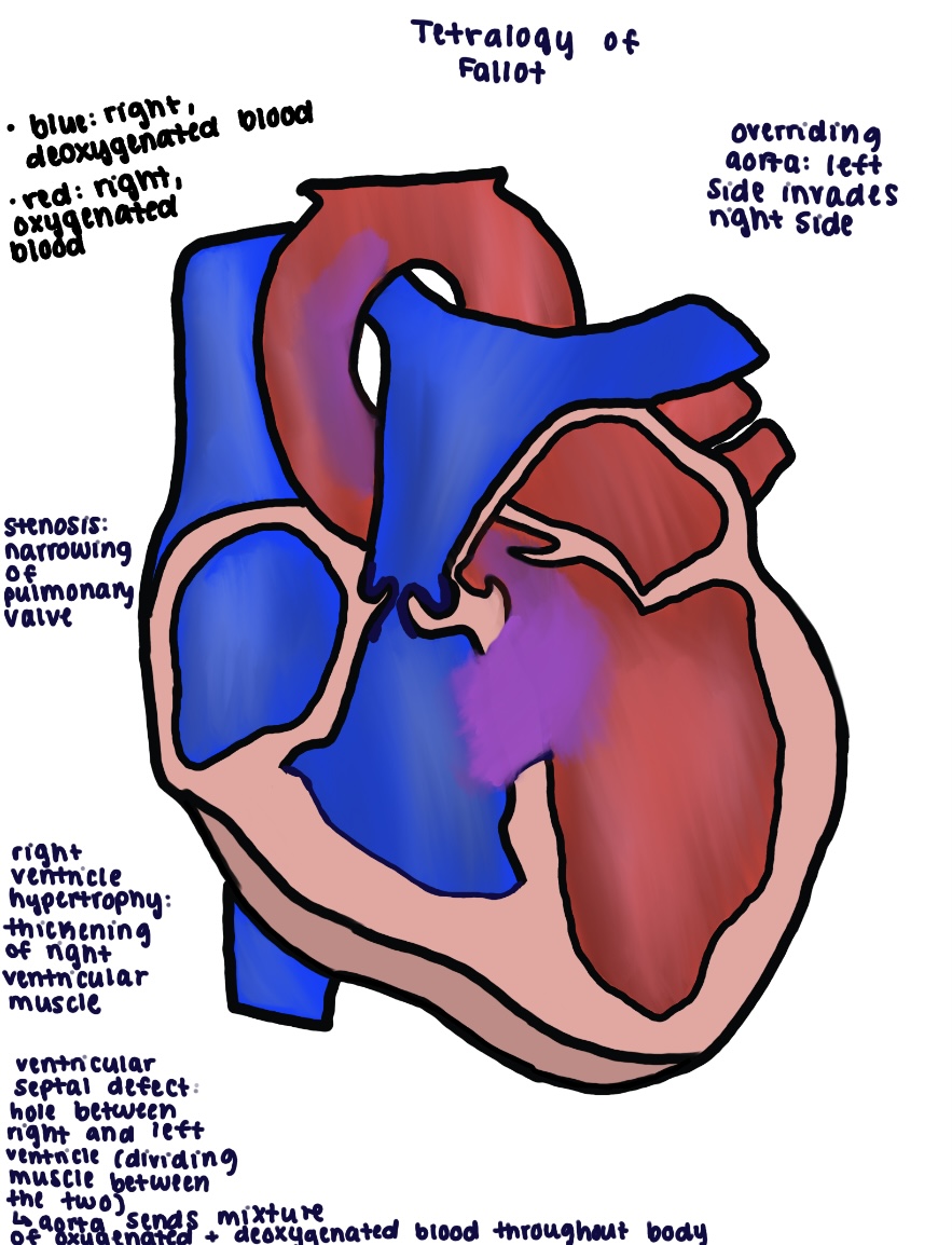 Fellow's annotated drawing of tetralogy of Fallot with stenosis, overriding aorta and septal defect notes