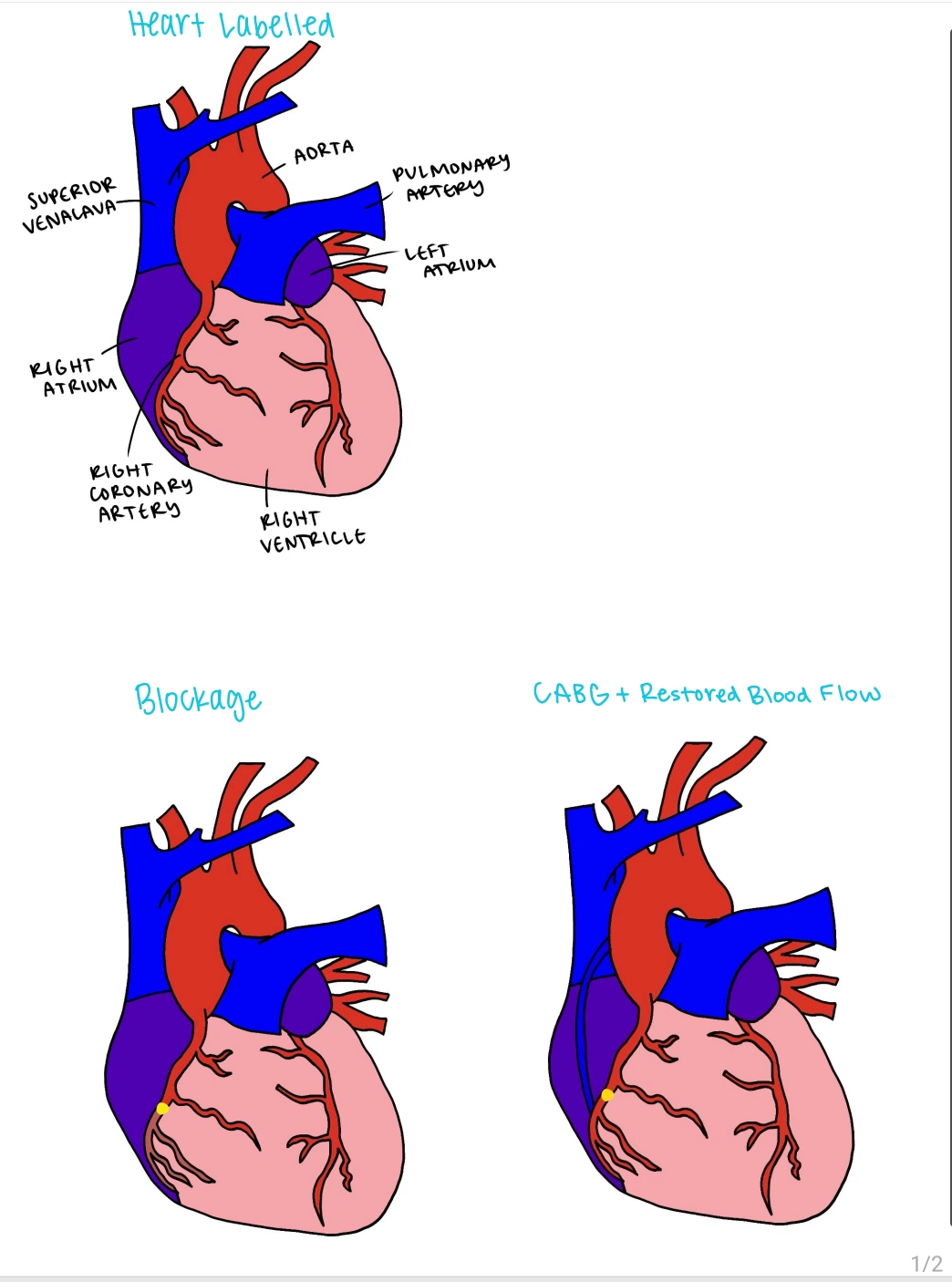 Fellow's labelled heart drawing with aorta, atria and coronary arteries, plus panels showing a blockage and restored blood flow after bypass surgery