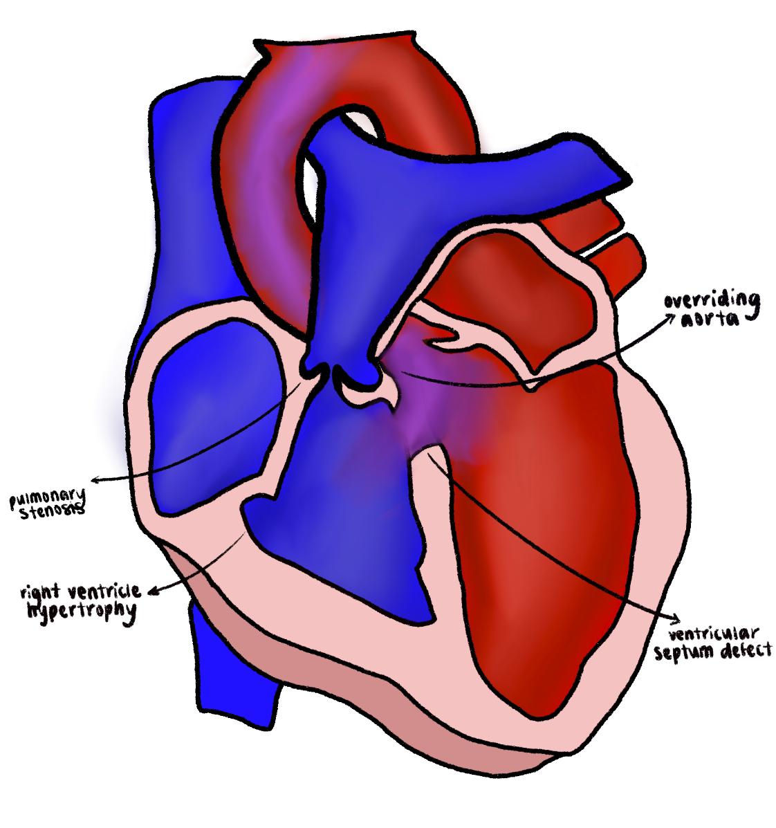 Fellow's drawing of tetralogy of Fallot with labelled overriding aorta, pulmonary stenosis, ventricular septal defect and right ventricular hypertrophy